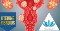 Fibroid Surgery in Cape Town