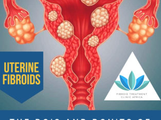 Fibroid Surgery in Cape Town
