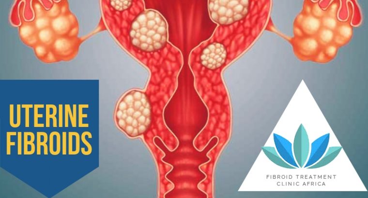 Fibroid Surgery in Cape Town