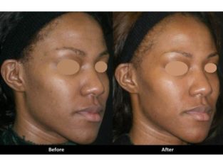 Bleach your skin with Rollyhampy skin care products +27797455644