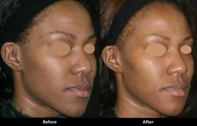 Rollyhampy skin lightening/ bleaching cream, pills and soaps
