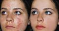 Get rid of pimples strech marks and spots with Rollyhampy skin