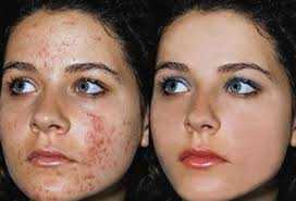 Get rid of pimples strech marks and spots with Rollyhampy skin