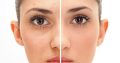 Get rid of pimples strech marks and spots with Rollyhampy skin