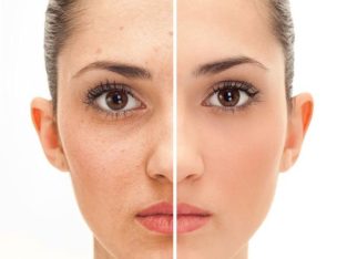Get rid of pimples strech marks and spots with Rollyhampy skin