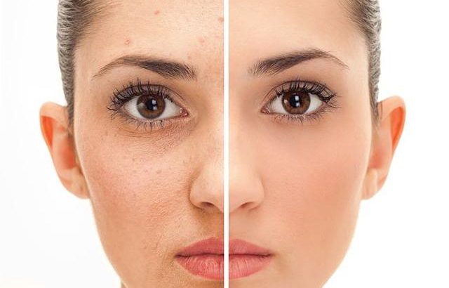 Get rid of pimples strech marks and spots with Rollyhampy skin