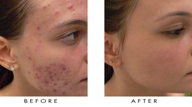 Get the clear glowing skin with Rollyhampy product +27760829927