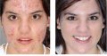 pimple removal cream from Rollyhampy +27797455644