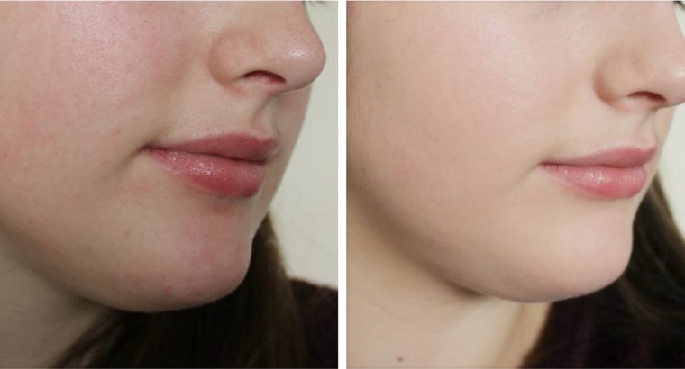 The most effective skin bleaching creams by Rollyhampy