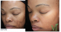 pimple removal cream from Rollyhampy +27797455644