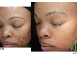 pimple removal cream from Rollyhampy +27797455644