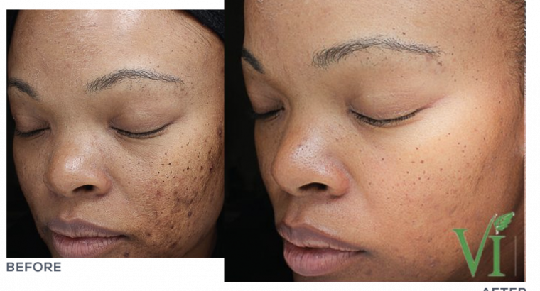 pimple removal cream from Rollyhampy +27797455644