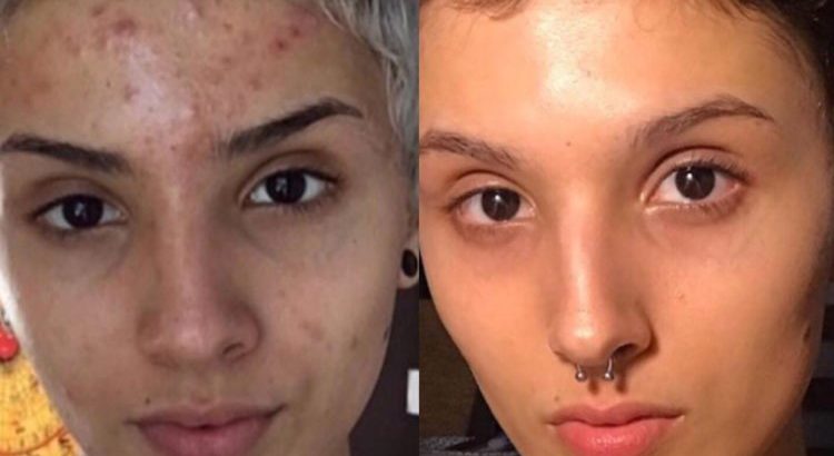 Make your skin visibly bright with Rollyhampy skin care