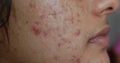 Lightens & Removes Mask of Pregnancy +27784024696