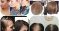 Intensive Hair & Scalp System