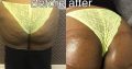 Boob and buttlift