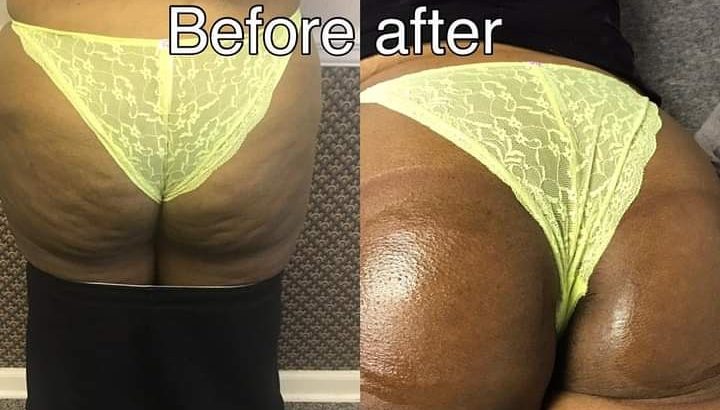 Boob and buttlift