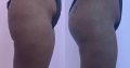 Boob and buttlift