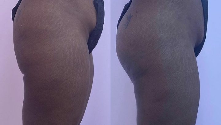 Boob and buttlift