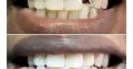 Dental treatment