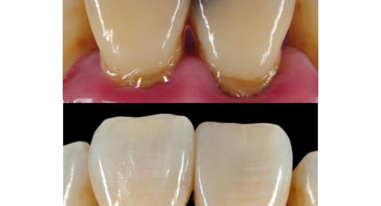 Teeth treatment in Kampala